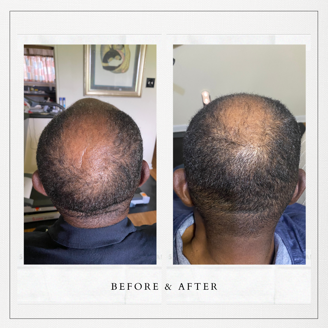 before and after photo of balding hair that was previously thin and is now thicker