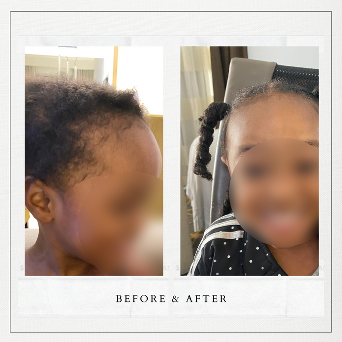 before and after photo of little girl's hair that was previously thin and is now thicker